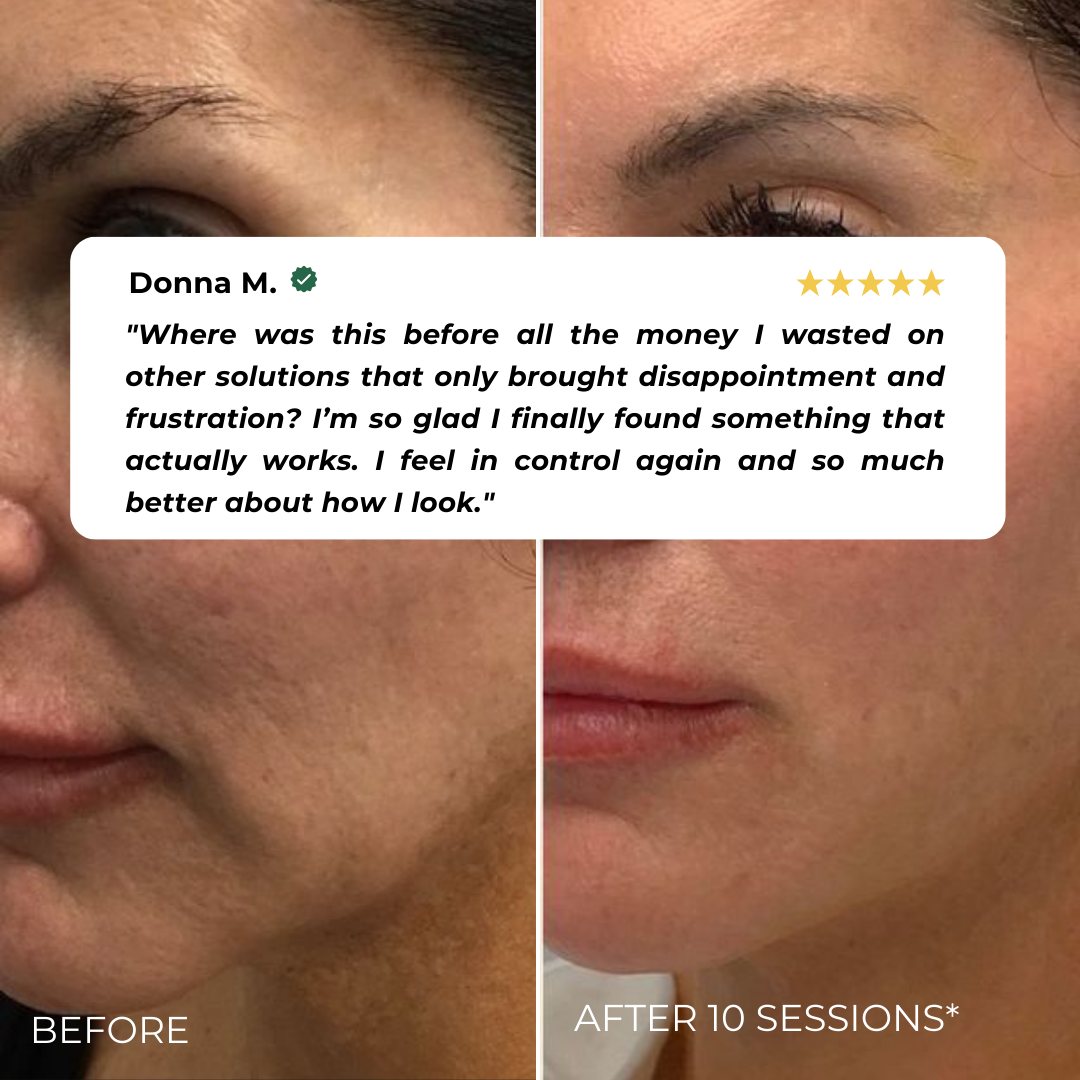 Elvia EMS Beauty Device