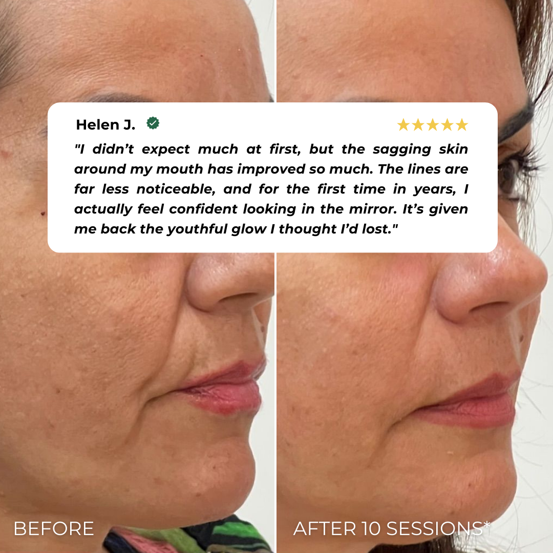 Elvia EMS Beauty Device